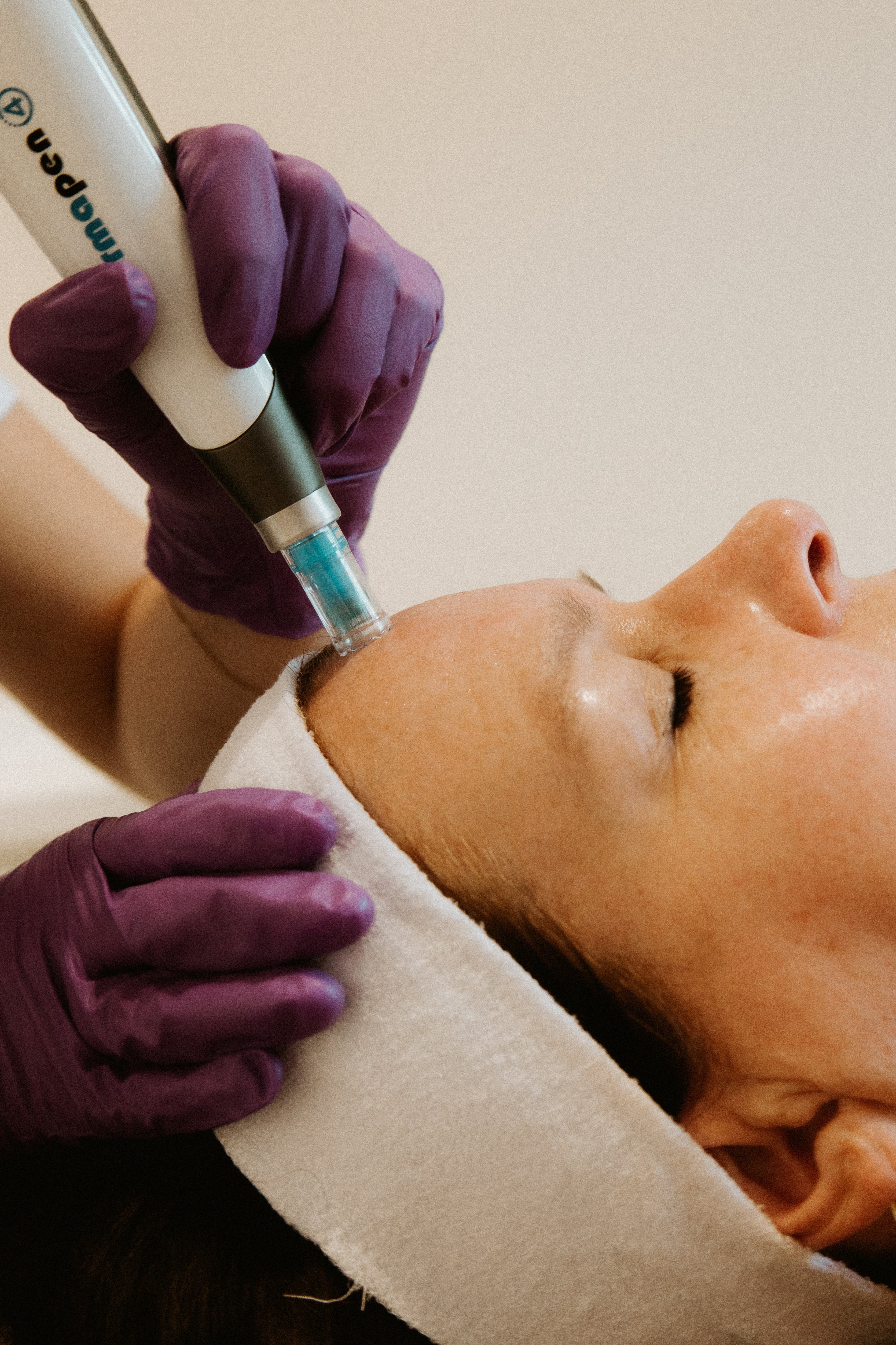 Prescription Personalized Microneedling