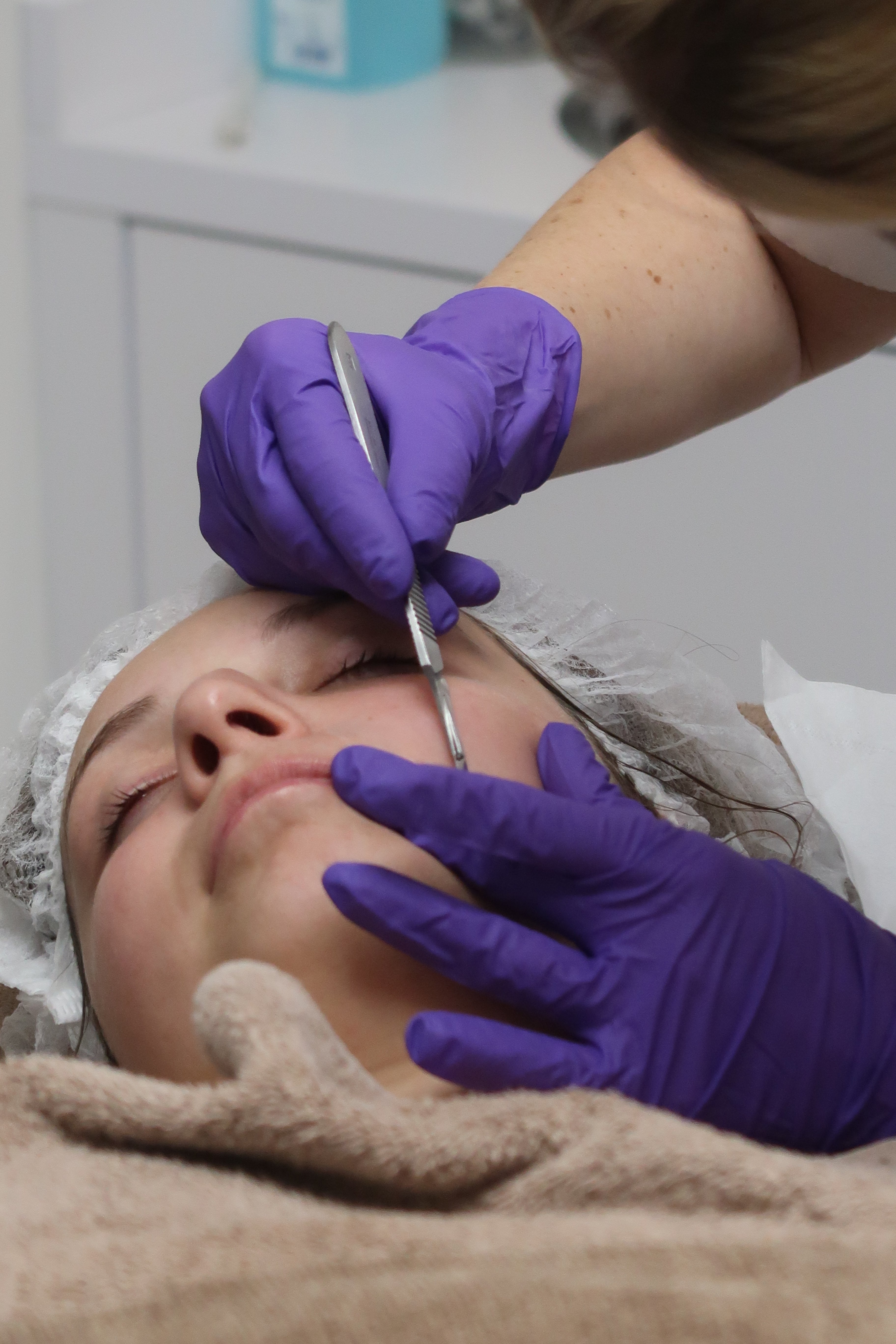 Prescription Dermaplaning Treatment